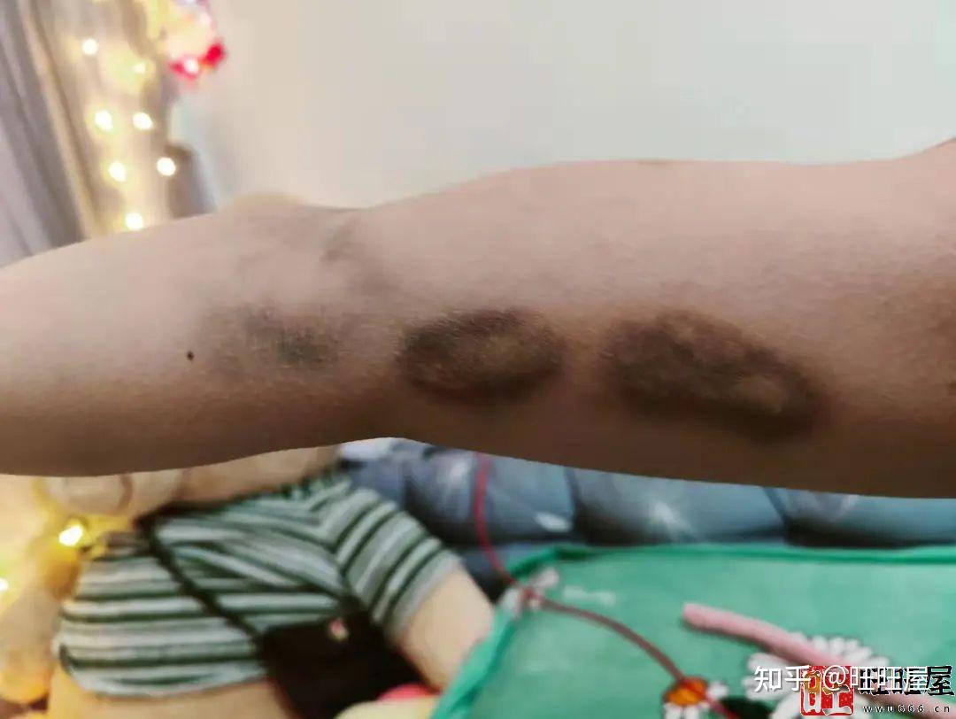 强行变道被撞翻 女子脑震荡暂时性失忆：不知自己在哪要干啥